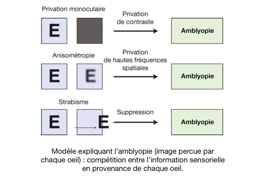 amblyopie schema dr kader belahda chirurgien ophtalmologue spécialiste strabisme cataracte paris