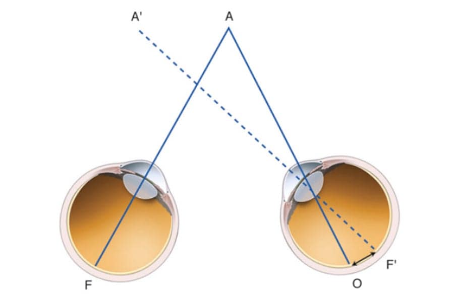 strabisme precoce schema dr kader belahda chirurgien ophtalmologue spécialiste strabisme cataracte paris